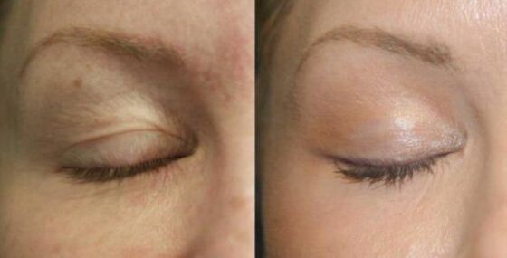 Keeping the area near the eyes