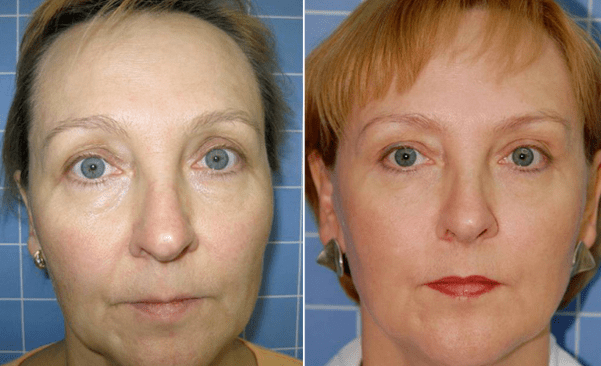 Before and after rejuvenating procedures