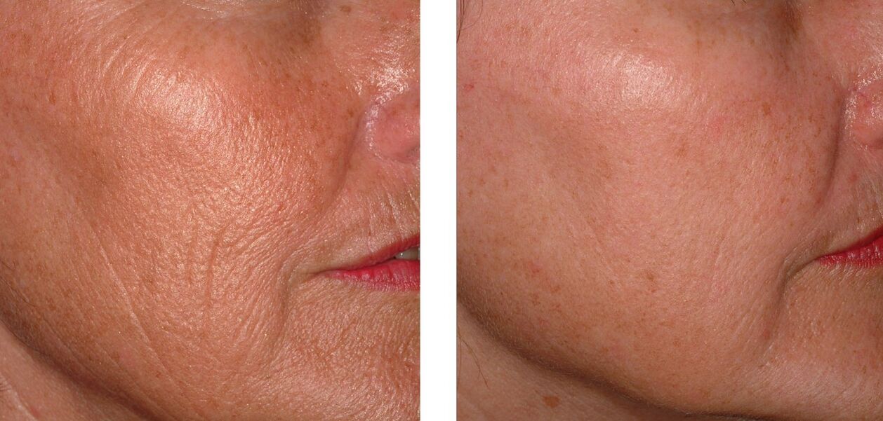 Skin rejuvenation