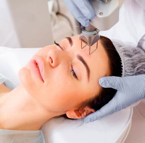 A facial laser rejuvenation
