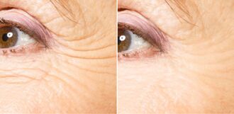 Before and after fractional rejuvenation
