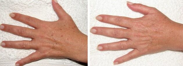 The result of removing pigment spots on the hands
