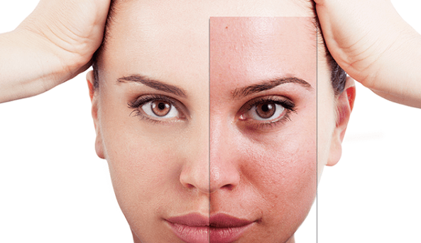 Fractional rejuvenation eliminates major aesthetic defects on the face