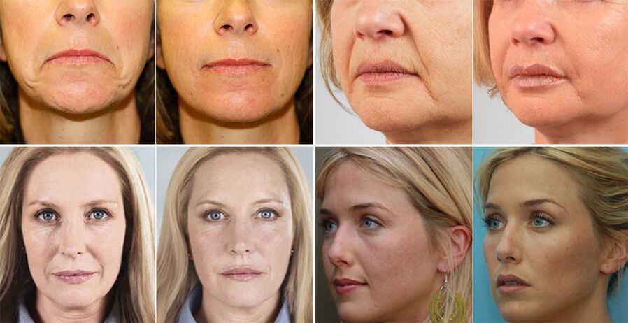 pictures of women before and after facial skin rejuvenation