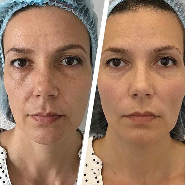 facial photos before and after laser rejuvenation