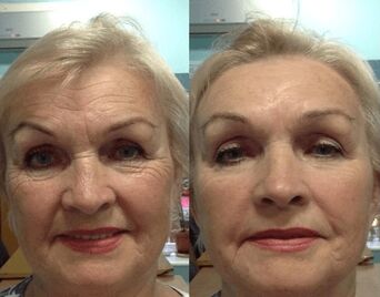 experience using Goji Cream anti-wrinkle cream - personal photos before and after